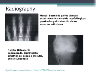 Radiography Manos. Edema de partes blandas especialmente a nivel de interfalángicas proximales y disminución de los espacios articulares Rodilla. Osteopenia generalizada, disminución simétrica del espacio articular, quiste subcondral http://www.encolombia.com/reuma722000-aspectos.htm   