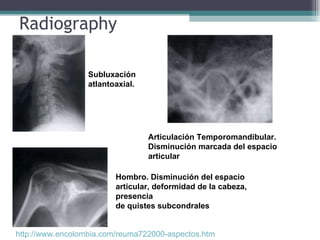 http://www.encolombia.com/reuma722000-aspectos.htm   Radiography Subluxación atlantoaxial. Articulación Temporomandibular. Disminución marcada del espacio articular Hombro. Disminución del espacio articular, deformidad de la cabeza, presencia de quistes subcondrales 