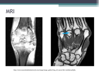 MRI http://www.musculoskeletalnetwork.com/image/image_gallery?img_id=1501277&t=1262897408585 