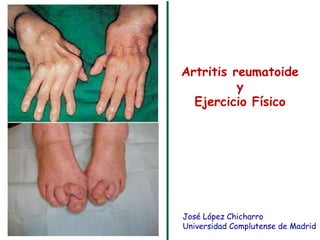 Artritis reumatoide
y
Ejercicio Físico
José López Chicharro
Universidad Complutense de Madrid
 