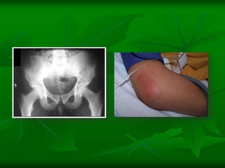 DISTRIBUCIÓN DE ARTICULACIONES AFECTADASRodilla				39.6 %Cadera				22.2 %Codo				14 %Tobillo				13.3 %Hombro			4.7 %Muñeca			4.4 %Sacroiliaca			0.6 %Interfalángica			0.5 %Metatarsiana			0.4 %Acromioclavicular		0.1 %Esternoclavicular		0.1 %Metacarpiana			0.1 %