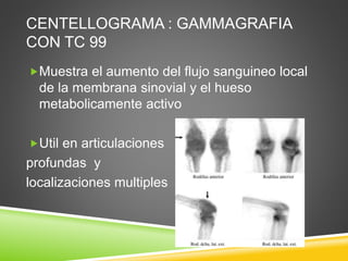 CENTELLOGRAMA : GAMMAGRAFIA 
CON TC 99 
Muestra el aumento del flujo sanguineo local 
de la membrana sinovial y el hueso 
metabolicamente activo 
Util en articulaciones 
profundas y 
localizaciones multiples 
 