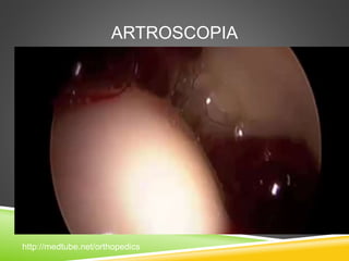 ARTROSCOPIA 
http://medtube.net/orthopedics 
 