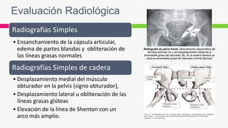 Evaluación Radiológica
Radiografías Simples
• Ensanchamiento de la cápsula articular,
edema de partes blandas y obliteración de
las líneas grasas normales
Radiografías Simples de cadera
• Desplazamiento medial del músculo
obturador en la pelvis (signo obturador),
• Desplazamiento lateral u obliteración de las
líneas grasas glúteas
• Elevación de la línea de Shenton con un
arco más amplio.
Radiografía de pelvis frente. Demostración esquemática del
derrame articular (A) y del desplazamiento medial de la
almohadilla grasa del obturador (B). En la cadera derecha se
observa almahadilla grasa del obturador normal (flechas)
 