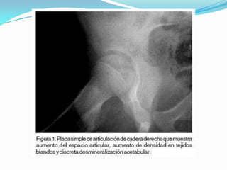 Cuadro ClínicoSegún la edad del paciente Lactantes:  Fiebre alta