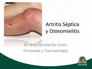 Artritis Séptica
y Osteomielitis
Dr. Noly Quintanilla Cerón
Ortopedia y Traumatología
 