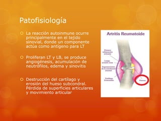 Patofisiología
 La reacción autoinmune ocurre
principalmente en el tejido
sinovial, donde un componente
actúa como antígeno para LT
 Proliferan LT y LB, se produce
angiogénesis, acumulación de
neutrófilos, edema y sinovitis
 Destrucción del cartílago y
erosión del hueso subcondral.
Pérdida de superficies articulares
y movimiento articular
 