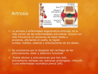 Artrosis
 La artrosis o enfermedad degenerativa articular, es la
más común de las enfermedades articulares. Ocurre con
más frecuencia en personas de edad media y
ancianos, afectando el cuello, la región
lumbar, rodillas, caderas y articulaciones de los dedos.
 Se caracteriza por el desgaste del cartílago de las
articulaciones, dolor y deterioro funcional
 Puede afectar a articulaciones que han sido
previamente dañadas por sobreuso prolongado, infección
o una enfermedad reumática previa (AR)
 