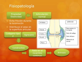 Fisiopatología
 Evita fricción durante
la locomoción
 Distribuye el peso en
la superficie articular
Propiedad
Elasticidad
Articulación
normal
Colágeno tipo
2
Agrecano
Condrocitos
Falla en el
recambio
continuo
Artrosis
 