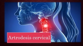 Artrodesis cervical
 