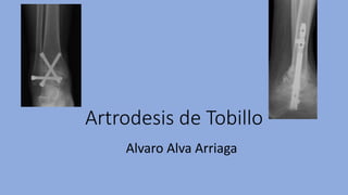 Artrodesis de Tobillo
Alvaro Alva Arriaga
 