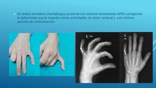 Artrodesis interfalangica  proximal 5 º dedo mano