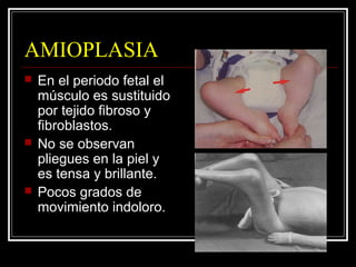 Artrogriposis Slide 18