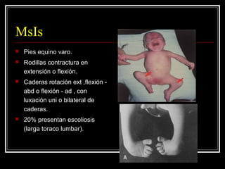 Artrogriposis Slide 19