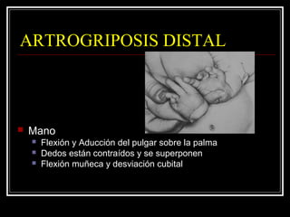 Artrogriposis Slide 21