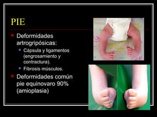 Artrogriposis Slide 28