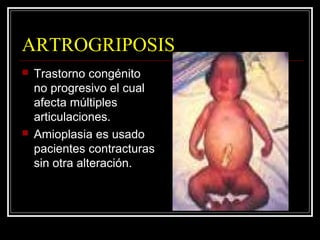 ARTROGRIPOSIS
 Trastorno congénito
no progresivo el cual
afecta múltiples
articulaciones.
 Amioplasia es usado
pacientes...