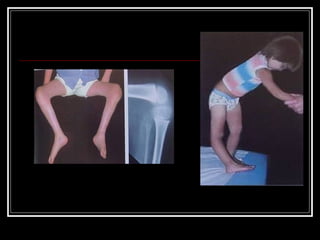 CADERA
 Contractura en abducción -- liberación
glúteos mediano
férulas durante la noche y
postura prona
Flexión cadera ye...
