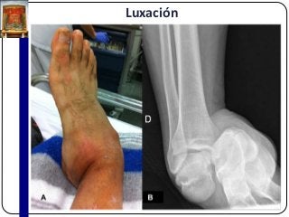 Luxación
 