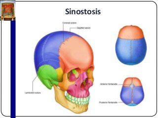 Sinostosis
 