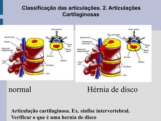 Classificação das articulações. 2. Articulações
Cartilaginosas
normal Hérnia de disco
Articulação cartilaginosa. Ex. sínfise intervertebral.
Verificar o que é uma hernia de disco
 