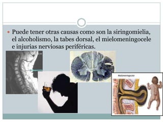  Puede tener otras causas como son la siringomielia,
 el alcoholismo, la tabes dorsal, el mielomeningocele
 e injurias nerviosas periféricas.
 