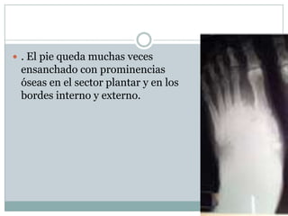  . El pie queda muchas veces
 ensanchado con prominencias
 óseas en el sector plantar y en los
 bordes interno y externo.
 