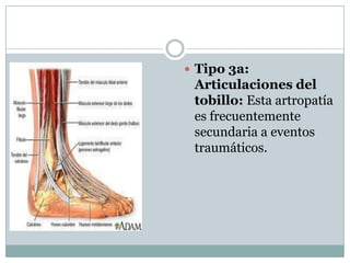  Tipo 3a:
 Articulaciones del
 tobillo: Esta artropatía
 es frecuentemente
 secundaria a eventos
 traumáticos.
 
