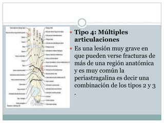  Tipo 4: Múltiples
  articulaciones
 Es una lesión muy grave en
  que pueden verse fracturas de
  más de una región anatómica
  y es muy común la
  periastragalina es decir una
  combinación de los tipos 2 y 3
  .
 