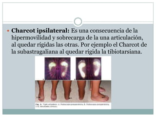  Charcot ipsilateral: Es una consecuencia de la
 hipermovilidad y sobrecarga de la una articulación,
 al quedar rígidas las otras. Por ejemplo el Charcot de
 la subastragaliana al quedar rígida la tibiotarsiana.
 
