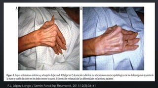 F.J. López Longo / Semin Fund Esp Reumatol. 2011;12(2):36–41

 