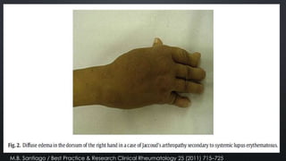 M.B. Santiago / Best Practice & Research Clinical Rheumatology 25 (2011) 715–725

 