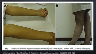 M.B. Santiago / Best Practice & Research Clinical Rheumatology 25 (2011) 715–725

 