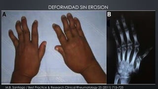 DEFORMIDAD SIN EROSION

M.B. Santiago / Best Practice & Research Clinical Rheumatology 25 (2011) 715–725

 