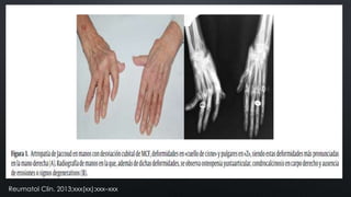 Reumatol Clin. 2013;xxx(xx):xxx–xxx

 