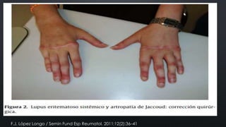 F.J. López Longo / Semin Fund Esp Reumatol. 2011;12(2):36–41

 