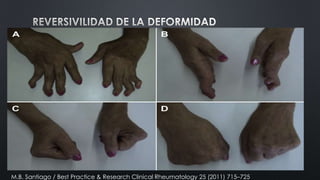 M.B. Santiago / Best Practice & Research Clinical Rheumatology 25 (2011) 715–725

 