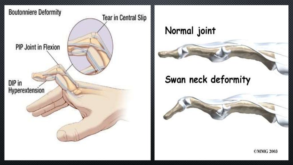 Artropatia de jaccoud