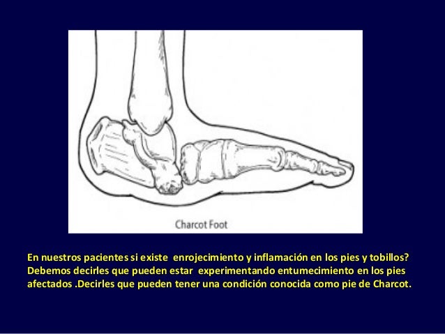 Artropatía neuropática diabética Artropatía neuropática diabética