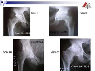 Grau I Grau II
Grau III Grau IV
 