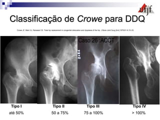 Classificação de Crowe para DDQ
Tipo I Tipo II Tipo III Tipo IV
até 50% 50 a 75% 75 a 100% > 100%
Crowe JF, Mani VJ, Ranawat CS. Total hip replacement in congenital dislocation and dysplasia of the hip. J Bone Joint Surg [Am] 1979;61-A:15–23.
 