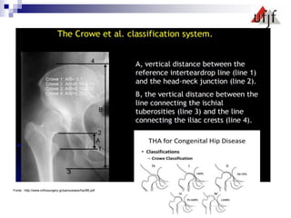 Fonte : http://www.orthosurgery.gr/parousiasis/hip/86.pdf
 