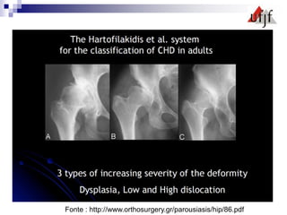 Fonte : http://www.orthosurgery.gr/parousiasis/hip/86.pdf
 