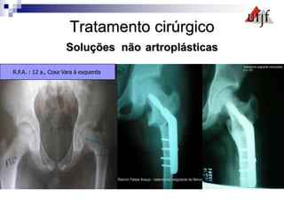 Tratamento cirúrgico
Soluções não artroplásticas
R.F.A. : 12 a., Coxa Vara à esquerda
 