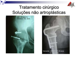 Tratamento cirúrgico
Soluções não artroplásticas
Varizante –DDQ-S.A.T-25 anos
12 meses FU
 
