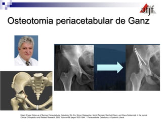 Osteotomia periacetabular de Ganz
Mean 20 year follow up of Bernise Periacetabular Osteotomy’ By Drs. Simon Steppacher, Moritz Tannast, Reinhold Ganz, and Klaus Seibenrock in the journal
Clinical Orthopedics and Related Research 2008, Volume 466 pages 1633-1644. - ‘Periacetabular Osteotomy: A Systemic Literat
 