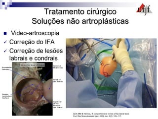 Tratamento cirúrgico
Soluções não artroplásticas
 Video-artroscopia
 Correção do IFA
 Correção de lesões
labrais e condrais
Varizante –DDQ-S.A.T-25 anos
12 meses FU
Groh MM & Herrea J A comprehensive review of hip labral tears
Curr Rev Musculoskelet Med. 2009 Jun; 2(2): 105–117.
 