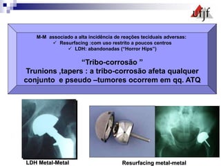 LDH Metal-Metal
M-M associado a alta incidência de reações teciduais adversas:
 Resurfacing :com uso restrito a poucos centros
 LDH: abandonadas (“Horror Hips”)
“Tribo-corrosão ”
Trunions ,tapers : a tribo-corrosão afeta qualquer
conjunto e pseudo –tumores ocorrem em qq. ATQ
Resurfacing metal-metal
 