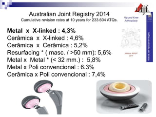 Australian Joint Registry 2014
Cumulative revision rates at 10 years for 233.604 ATQs.
Metal x X-linked : 4,3%
Cerâmica x X-linked : 4,6%
Cerâmica x Cerâmica : 5,2%
Resurfacing * ( masc. / >50 mm): 5,6%
Metal x Metal * (< 32 mm.) : 5,8%
Metal x Poli convencional : 6.3%
Cerâmica x Poli convencional : 7,4%
 