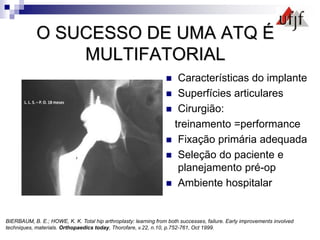O SUCESSO DE UMA ATQ É
MULTIFATORIAL
 Características do implante
 Superfícies articulares
 Cirurgião:
treinamento =performance
 Fixação primária adequada
 Seleção do paciente e
planejamento pré-op
 Ambiente hospitalar
BIERBAUM, B. E.; HOWE, K. K. Total hip arthroplasty: learning from both successes, failure. Early improvements involved
techniques, materials. Orthopaedics today, Thorofare, v.22, n.10, p.752-761, Oct 1999.
 